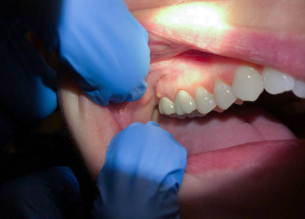 Best Emergency Dental Care for Broken or Chipped Teeth in Woodmont, CT